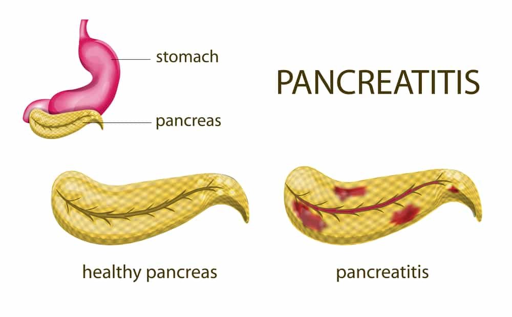 Câncer de Pâncreas: Quais as causas, sintomas e o Tratamento 1