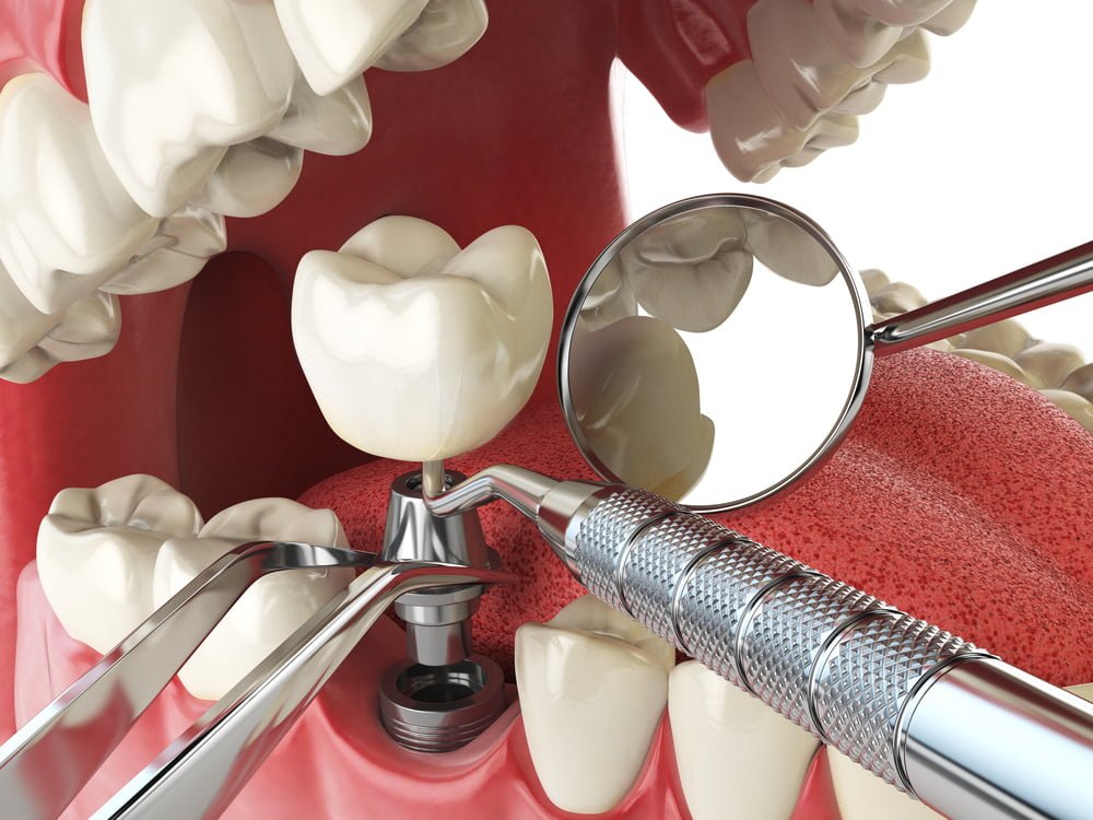 Implante dentário: o que é, quando é indicado e como é feito 3